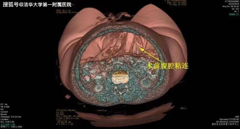 术后腹腔粘连的精准微创诊疗_临床_手术_患者