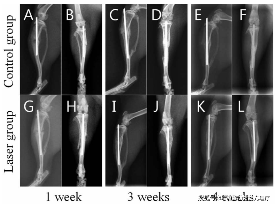 文献解读：半导体激光（808 nm）对大鼠胫骨骨折的骨愈合效果