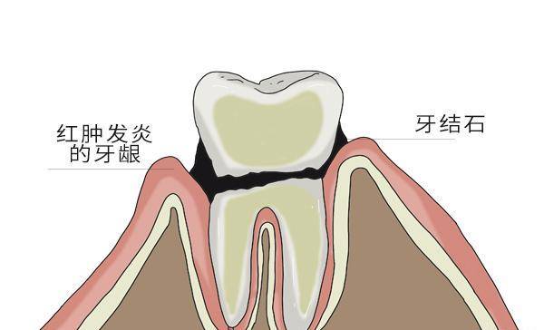 为什么医生建议每年洗牙一次？明明每天都刷牙，也需要洗牙吗？