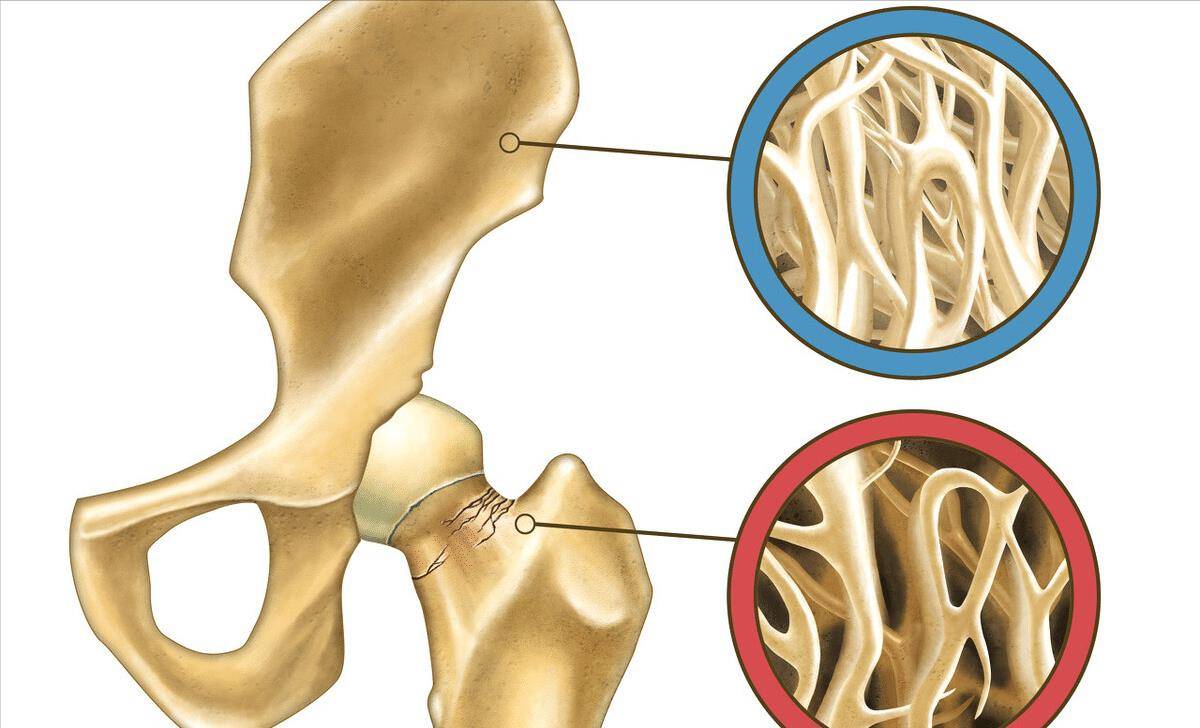 骨量松散有多可怕？只要老年人才有么？那3类人群要警觉