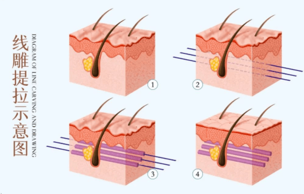 说实话：线雕面部提拔会不会越来越松？线雕几年后会更衰老吗？