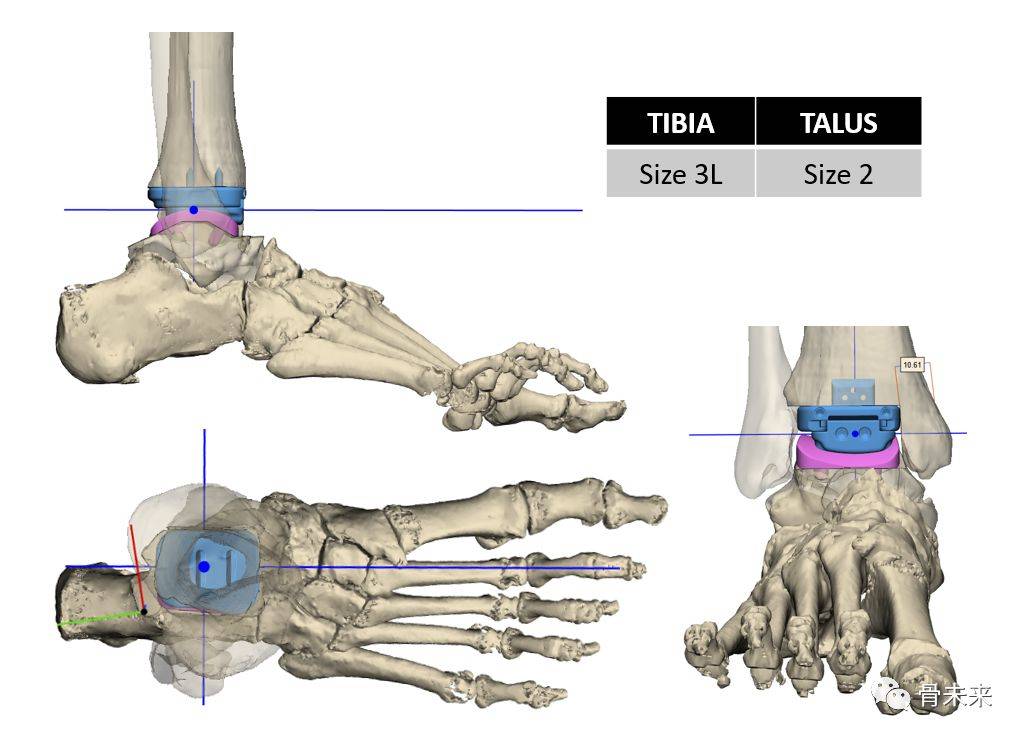 首款！定造系统用于全踝关节置换