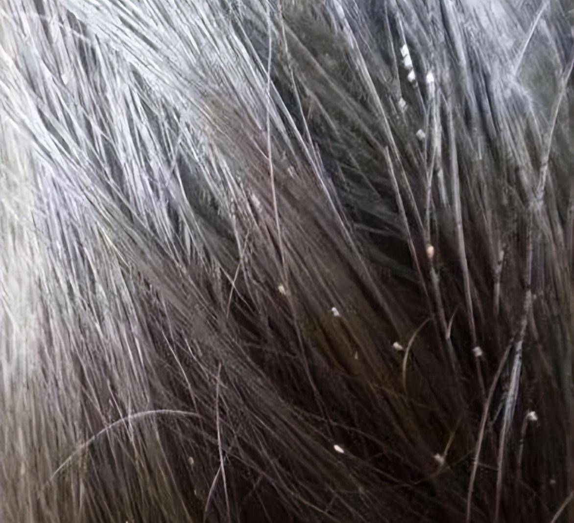 七八十年代人身上的虱子是怎么来的，我们该如何防治？