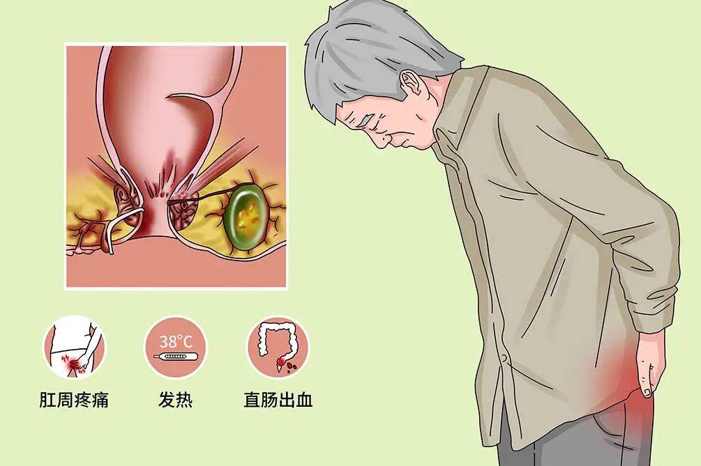 肛门有口子总是流脓怎么回事，可能你患了肛瘘！
