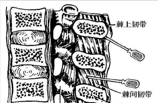 腰痛的一万个理由，但是棘上、棘间韧带损伤绝对不可以忽略