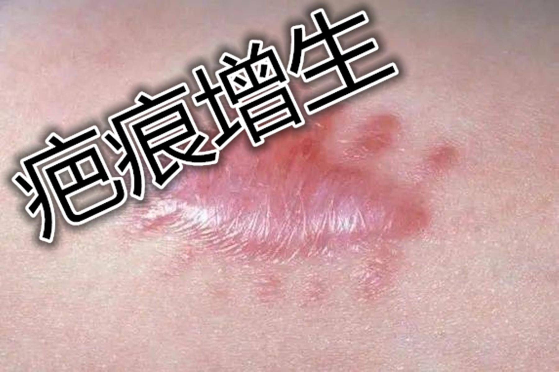 常见的疤痕修复手段！协和博士告诉你如何有效祛疤！丨协和医院去疤痕的药膏有哪些