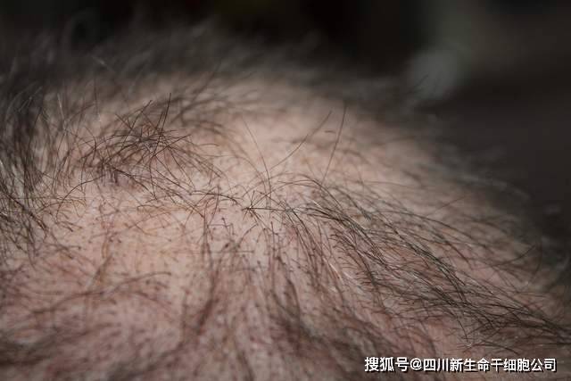 6个月的随访后，他们发现，所有脱发者的头发数量/密度都有明显改善。[4]