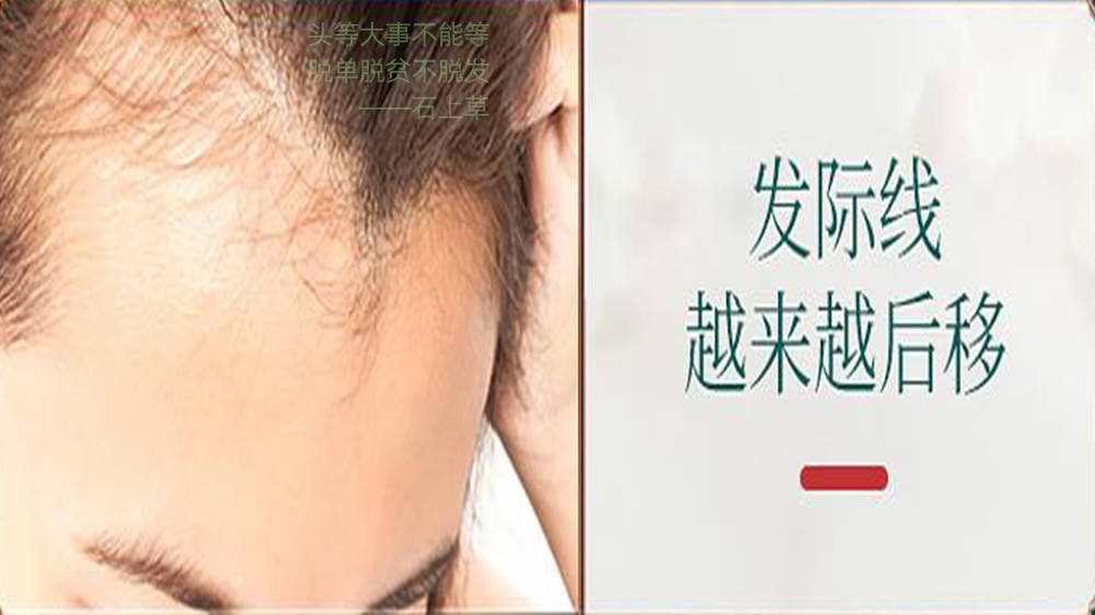头发出油用啥洗发水？防脱发私藏方法真的牛️
