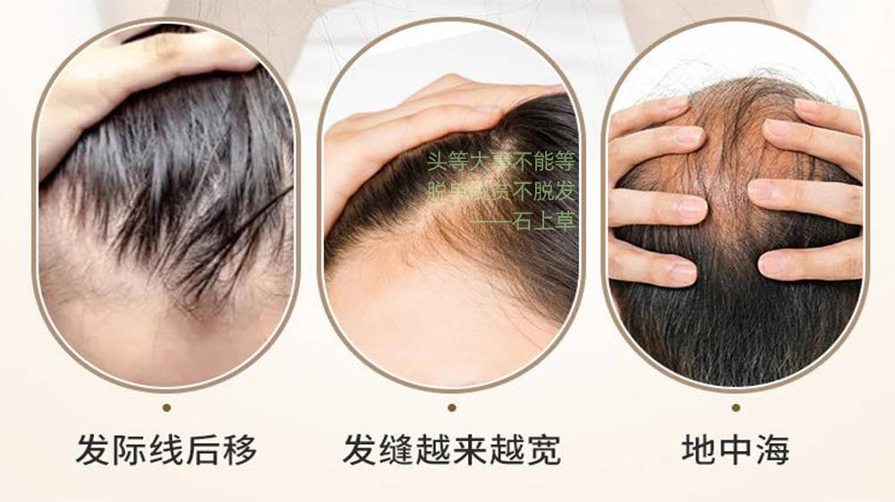 满满干货（什么洗发水增发又防脱发）哪种洗发水增发效果好，什么洗发水增发?防脱生发洗发水真牛掰!，