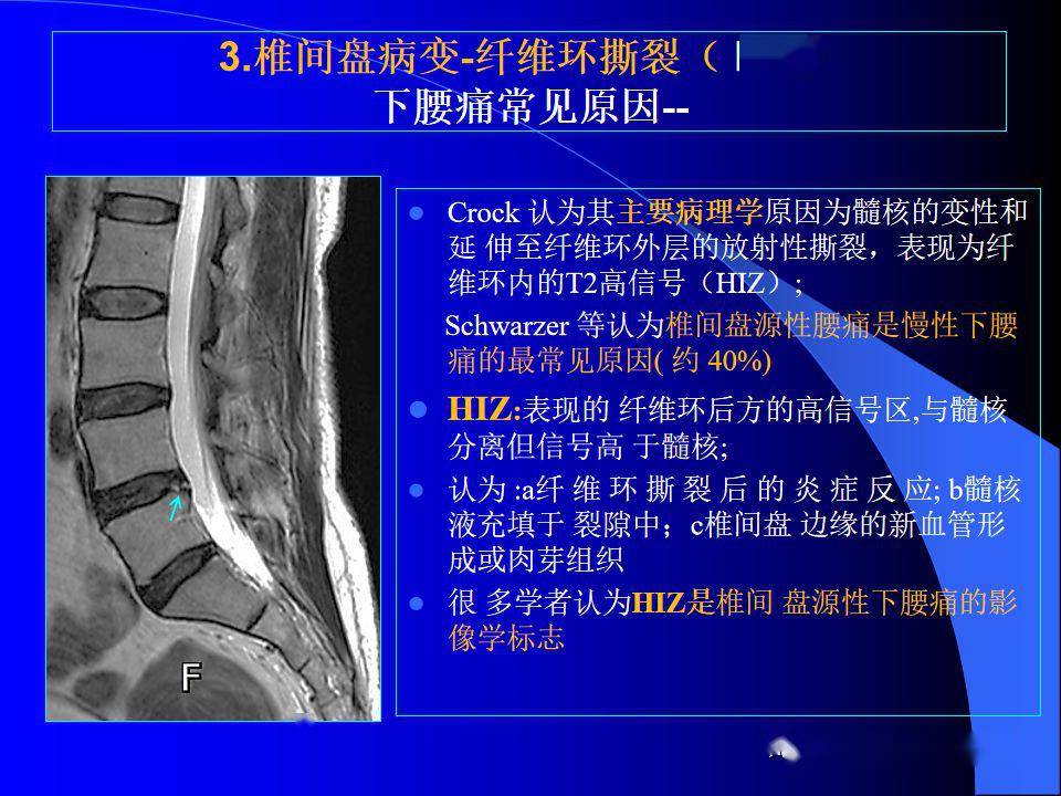 椎间盘发育退变与病变mri表现