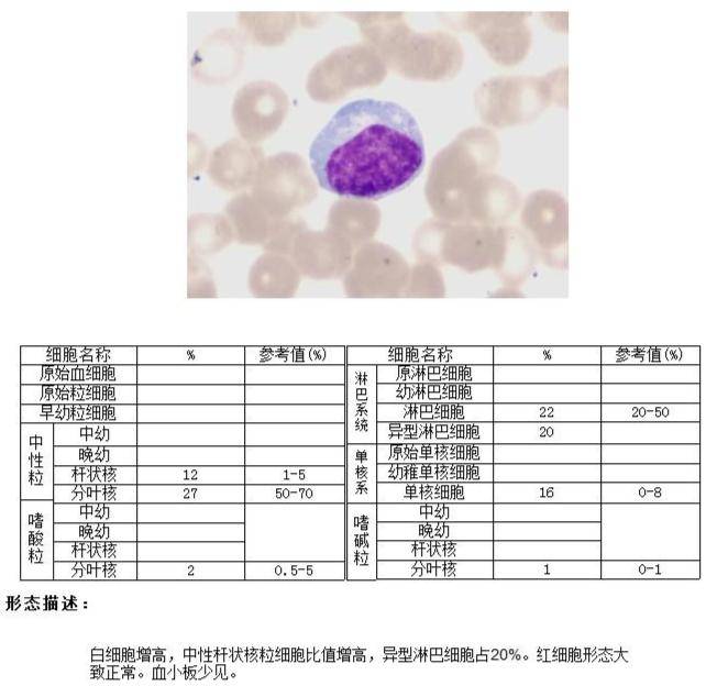 血常规:白细胞,单核细胞分类均明显增高,血小板数量极度减少.