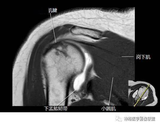 断层解剖肩关节磁共振