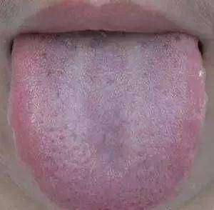 舌头是人体自带的体检表,出现这个信号小心了!_舌苔