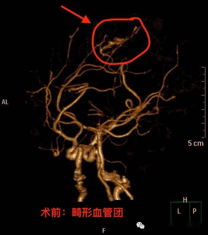 脑动静脉畸形出血切除1例