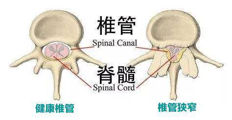 微创侧路融合术巧治腰椎管狭窄