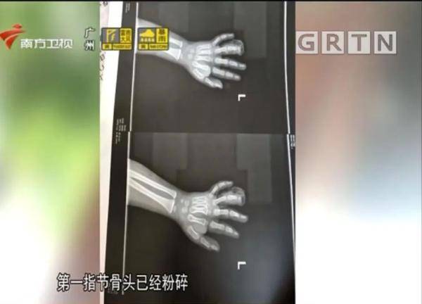 「肖女士」导致截肢！很多小区都有，4岁男孩手指被这种健身器械所伤