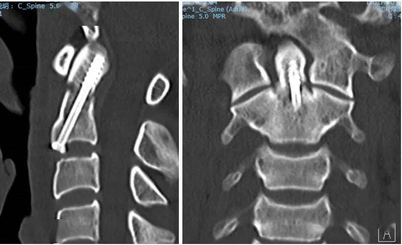 柳工医脊柱外科成功完成一例o臂导航下齿状突骨折前路