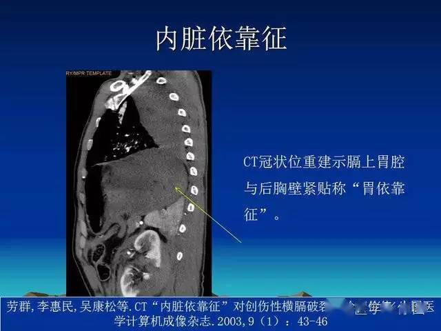 膈疝影像学表现
