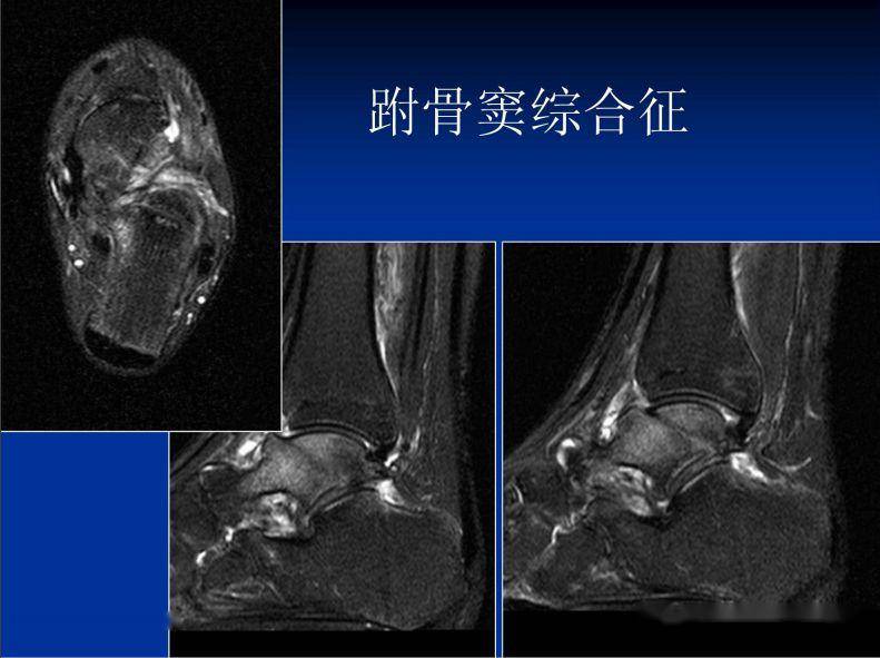 跗骨窦综合征临床与影像