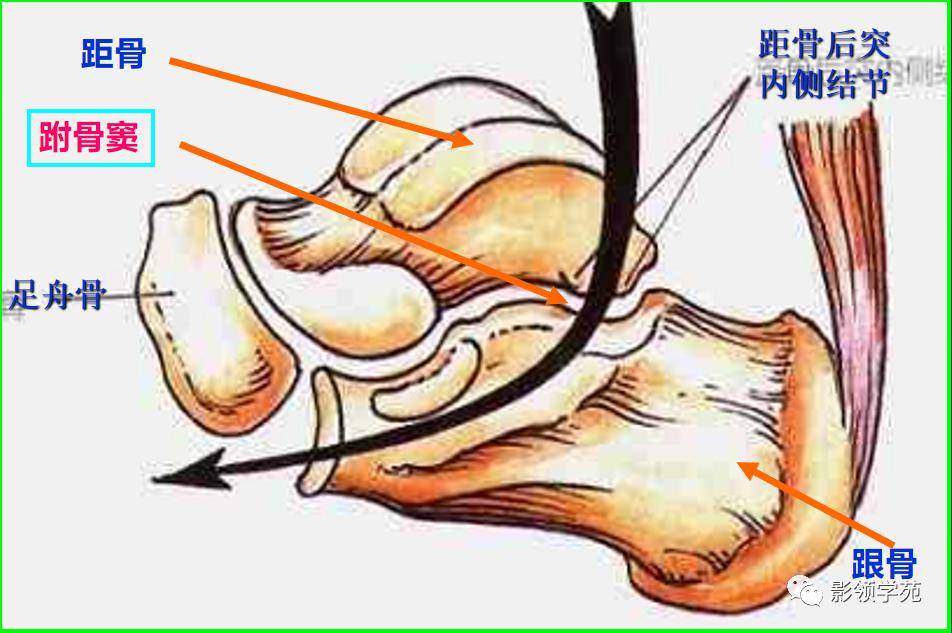 跗骨窦综合征影像诊断