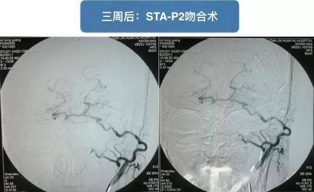 67手术实战佟小光脑血管搭桥十年回顾之四