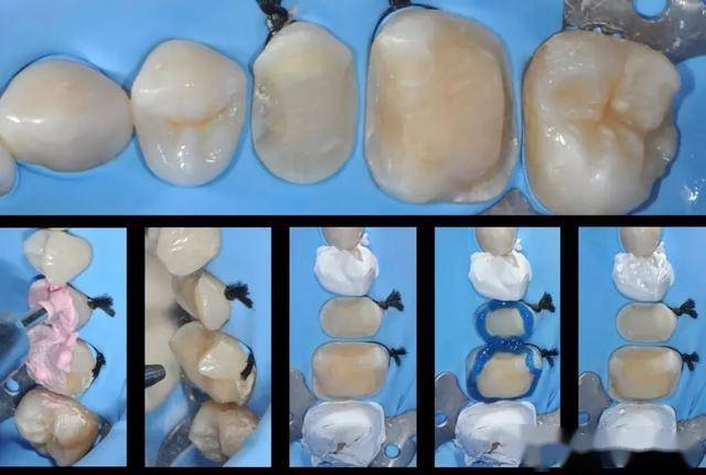 2526大面积龋坏去腐后嵌体修复病例