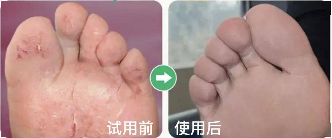 你的脚气有救了!5秒疼痒全消,多年香港脚也一喷"生香"