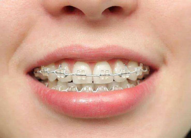 儿童牙齿矫正的黄金时期,家长们一定不要错过!