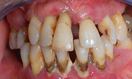 小孩子需要洗牙吗?洗完牙会使牙缝变大吗?洗牙可以使牙齿美白吗?