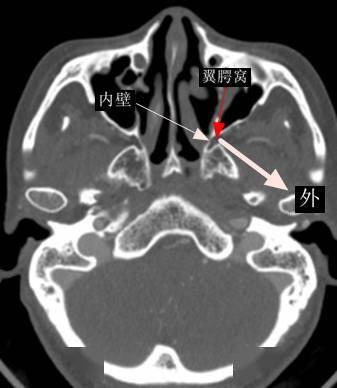 颅中窝后下:腭鞘管-鼻咽内:蝶腭孔-鼻腔外:翼上颌裂-颞下窝下