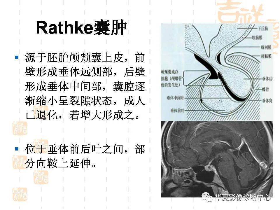 侵袭性垂体瘤的mri 征象