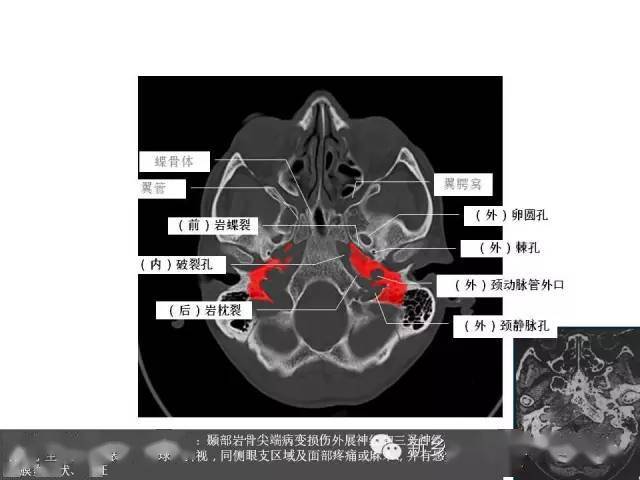 鼻咽部的详细解剖(含各个孔道)