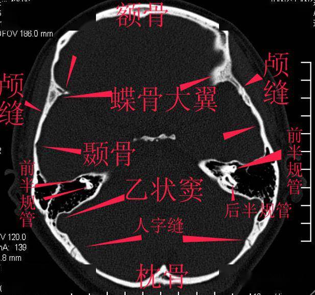 纯手工详细标注的颅底解剖太赞了