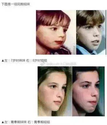 而鼻炎对  儿童的危害更大,如果因鼻腔堵塞而  长期用嘴呼吸,不仅各种