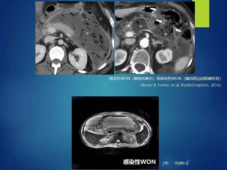 干货 急性胰腺炎,影像科医生需知道什么?