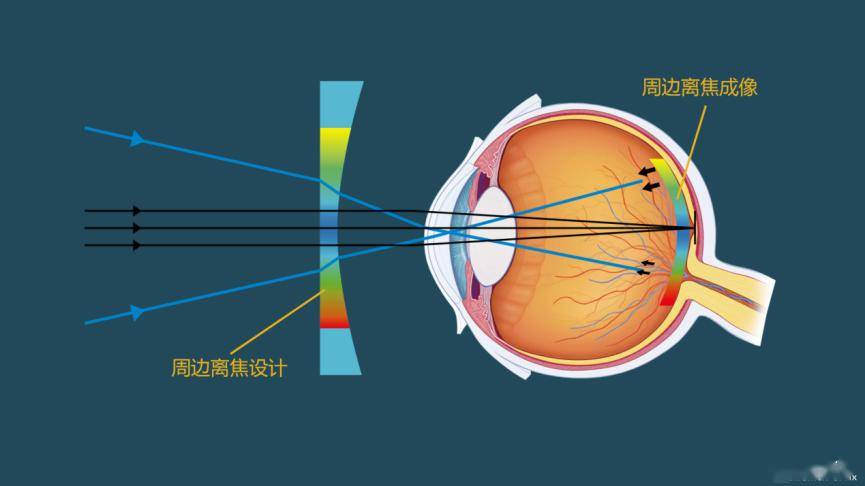 树脂近视镜片是什么原理_近视镜片h是什么牌子(3)