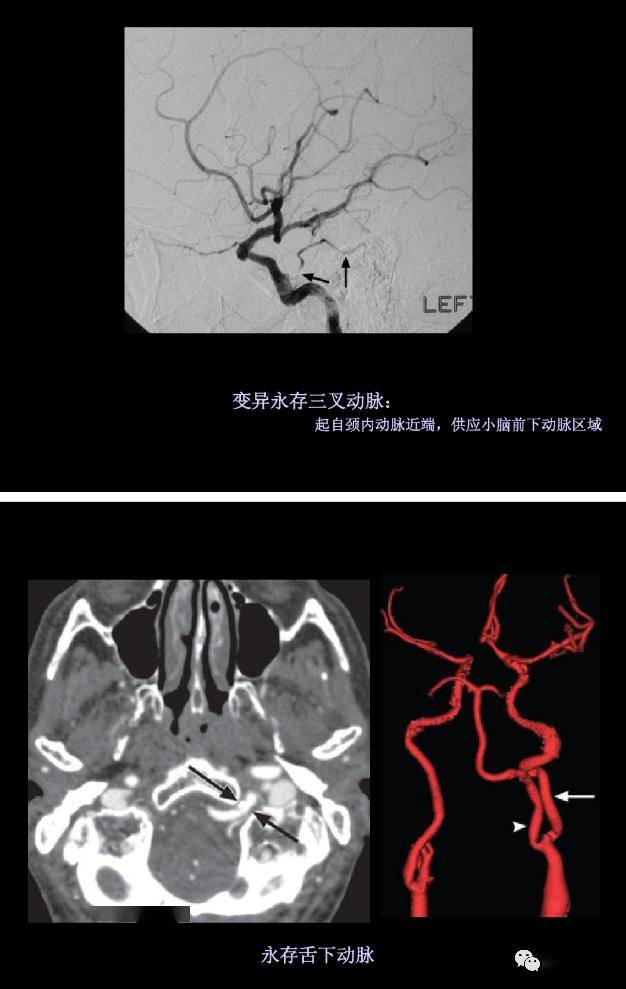 图解脑动脉的正常变异_大脑