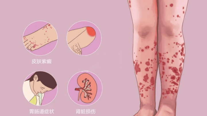 什么是过敏性紫癜?
