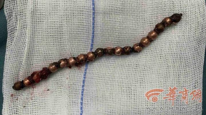 11岁内向男孩膀胱取出19颗磁力珠,你怎么看?