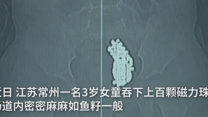 3岁女童吞下上百颗磁力珠,肠道密密麻麻如鱼籽,是家长不称职吗?