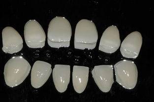 房山优贝口腔-超薄瓷贴面的牙体制备