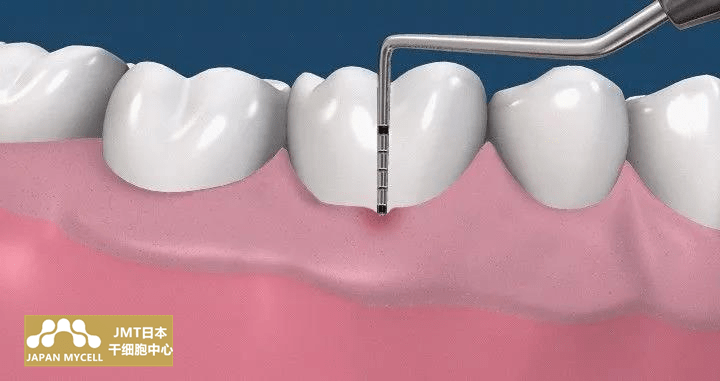 jmt日本干细胞治疗牙周病-关于牙周病的疑问①