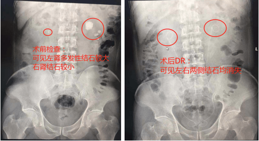 衡阳男子双肾结石多次就诊未果 正生医生当天完成微创取石保护了肾