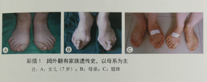 广药三院|遗传造成的大脚骨外翻要怎么治?