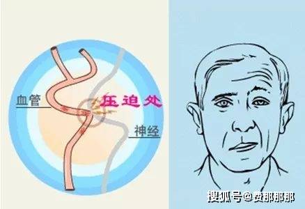 哪些血管容易压迫面神经导致面肌痉挛?