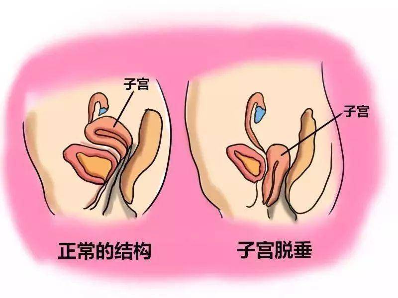 西安交大一附院李旭东:盆底器官脱垂-子宫脱垂预防及盆底重建治疗