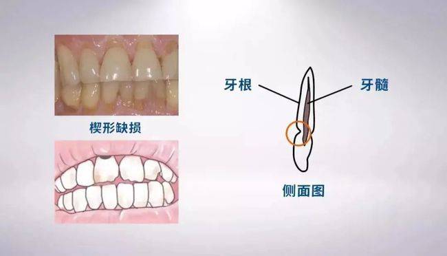 汕头日报 刷牙不当致楔状缺损 医生提醒,刷牙应讲究方式