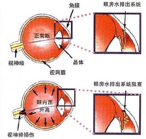 急性闭角性青光眼的主要症状