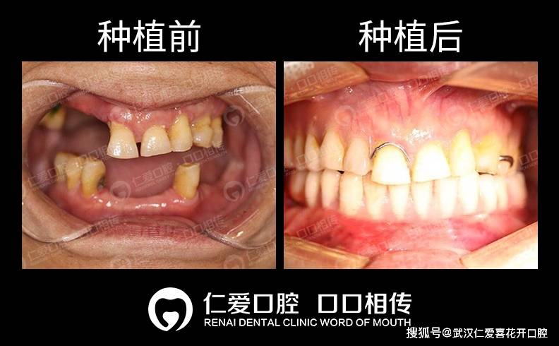 武汉仁爱口腔【半口种植】all-on-6即拔即种即刻修复,当天种牙当天用!