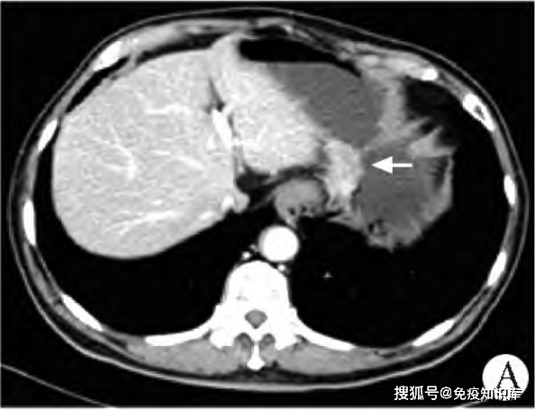 79岁确诊胃癌晚期并且伴随多项疾病最终靠这个疗法成功切除病灶